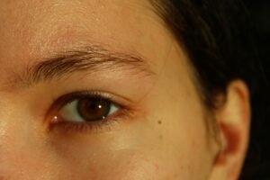 acne skincare woman